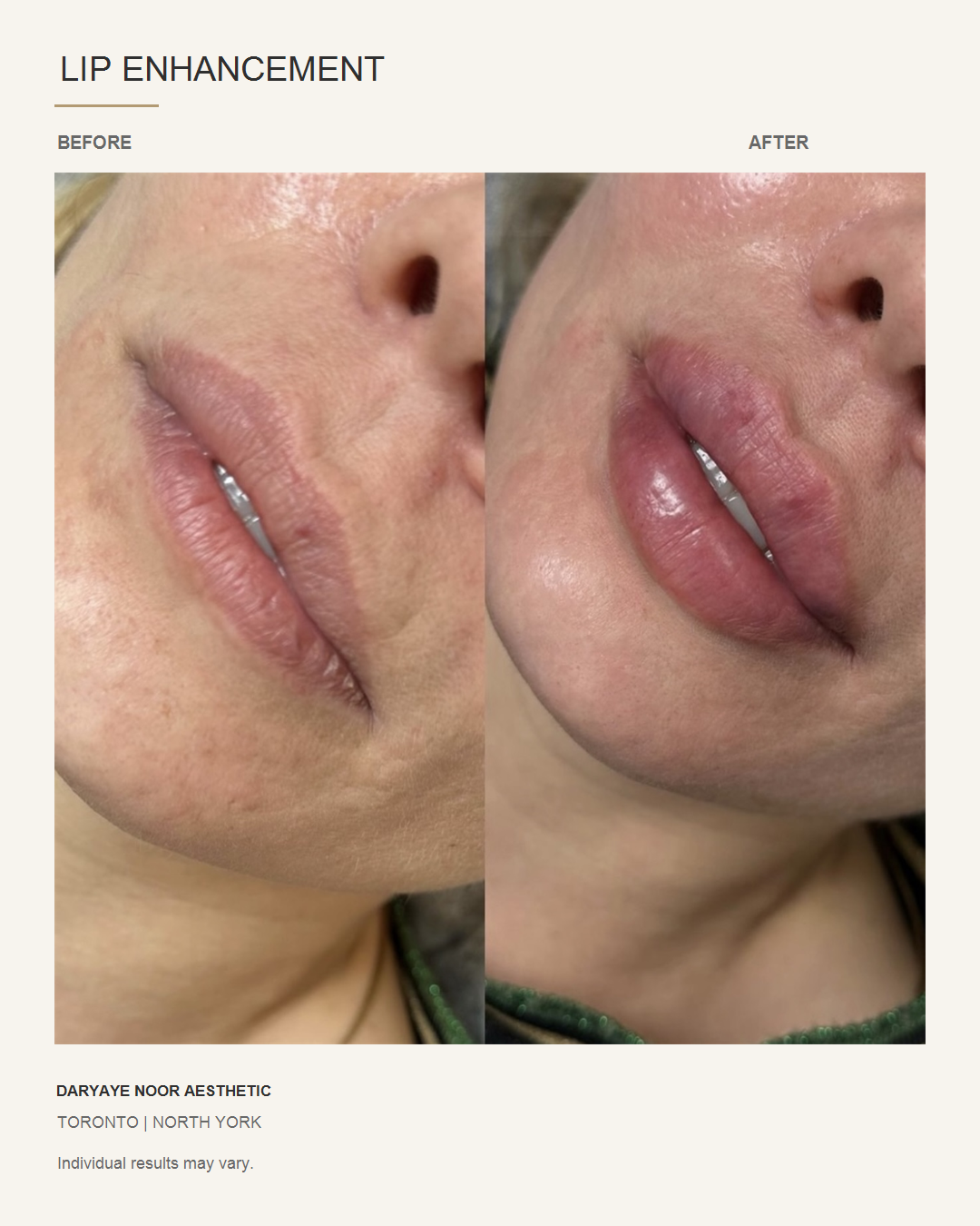 Side-by-side lip enhancement before and after