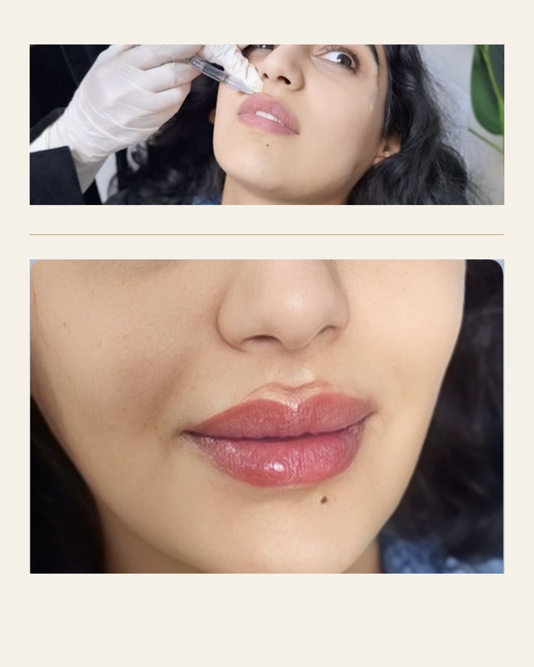 Lip procedure detail and finished result