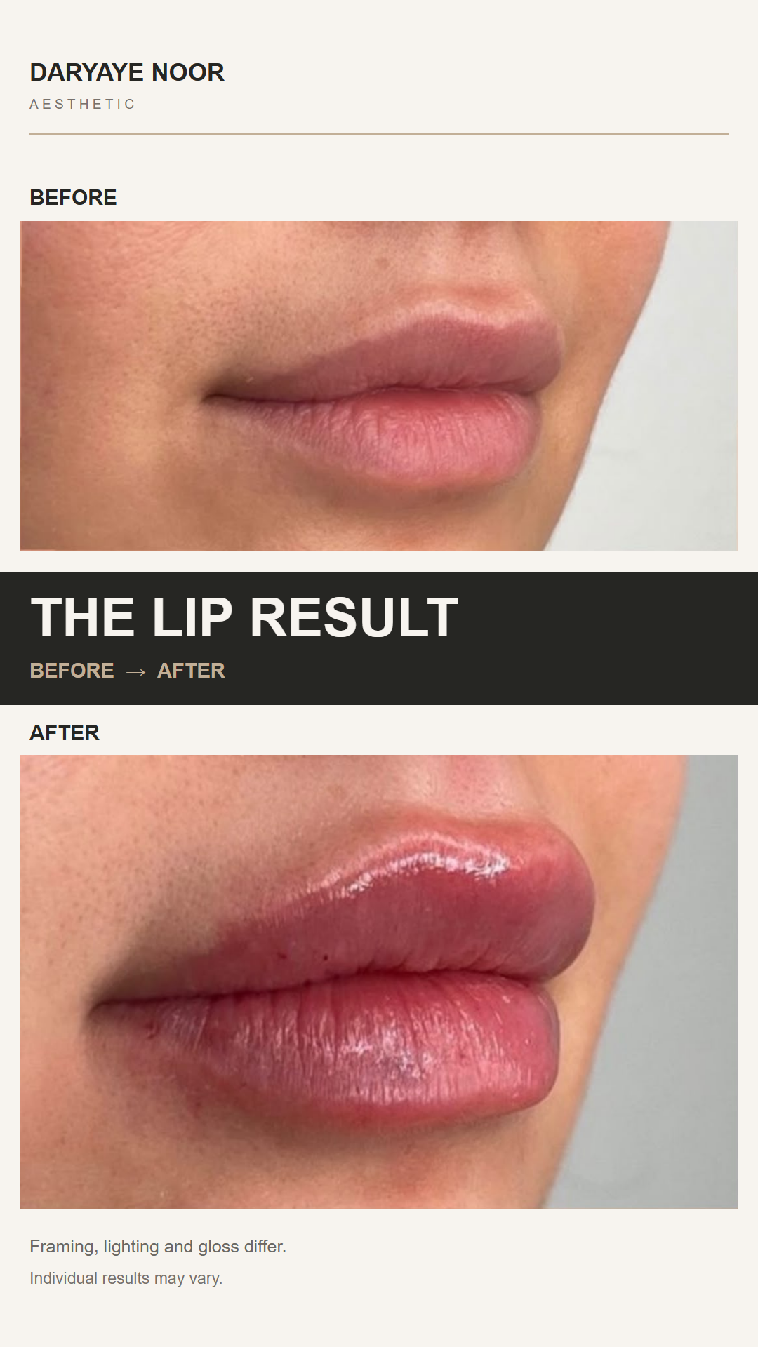 Lip result in an angled before and after comparison